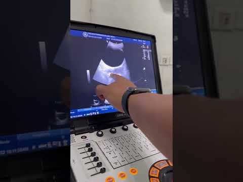 Hematometrocolpos: Imperforate hymen causing severe pain in young female #radiology #ultrasound