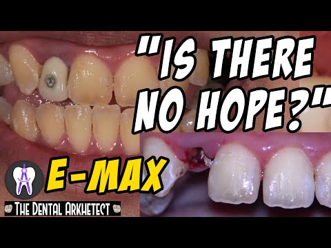 Restoring A Heavily Fractured Tooth! With A Post and E-Max Crown #C18 4K