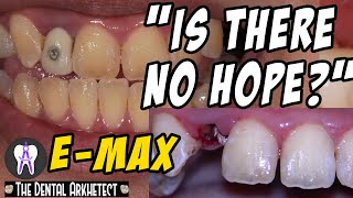 Restoring A Heavily Fractured Tooth! With A Post and E-Max Crown #C18 4K