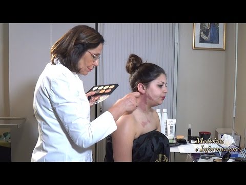 Camouflage per nascondere le discromie cutanee (vitiligine, angiomi, cicatrici)