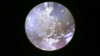 Dust Mites In Human Ears Feed On Skin