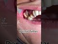 Dental Cleaning, Dental Scaling #tiktok #viral #video #fyp #funny #love #dentist