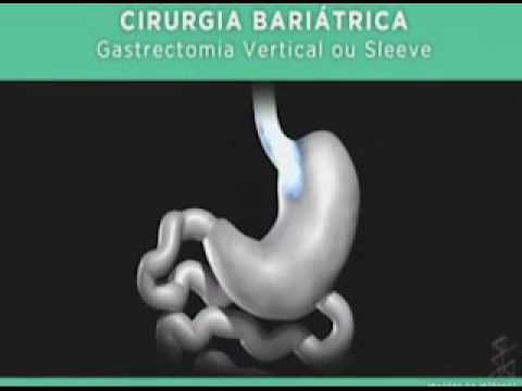 VIVER BEM - Cirurgia bariátrica - 1 - Gente de Opinião