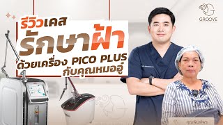Pico รักษาฝ้า 4 ครั้ง