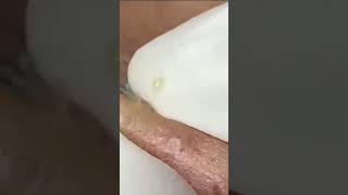Removendo cravos e espinhas do rosto - Tratamento para pele - Vídeo Satisfatório 😱