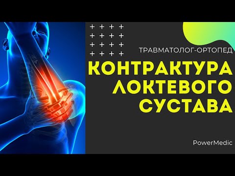 Контрактура локтевого сустава. Разработка и лечение локтевого сустава!