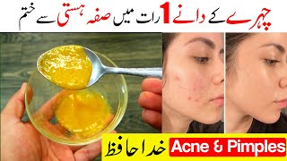 How To Remove Acne Pimples In 1 Night | Fast Acne Treatment | Pimples |  Home Remedies For Pimples