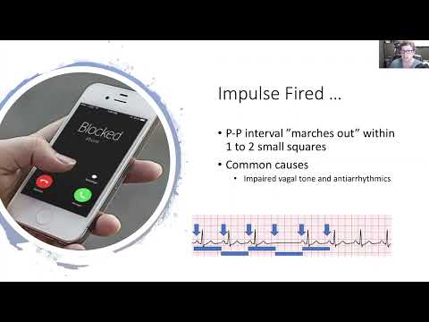 ECG rhythms for Nurses: Sinus block and Sinus arrest