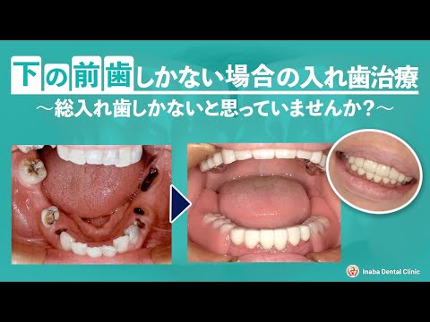 下の前歯しかない場合の入れ歯治療〜総入れ歯しかないと思っていませんか?〜