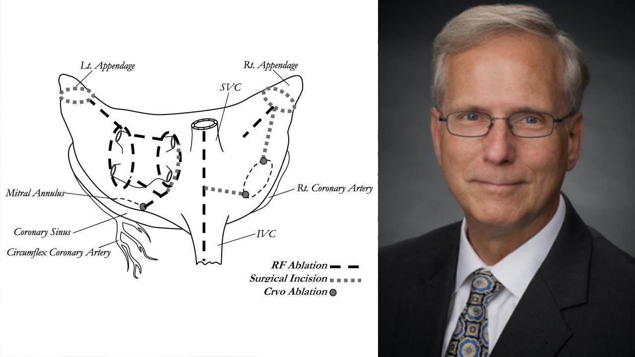Glenn Barnhart, MD – The Cox-Maze IV Procedure: Principals to Practice