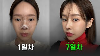 EDITION TV - "비결이 대체 뭘까"… 연예인 코 맛집이라는 이곳에서 코수술 하면 부기가 없다?