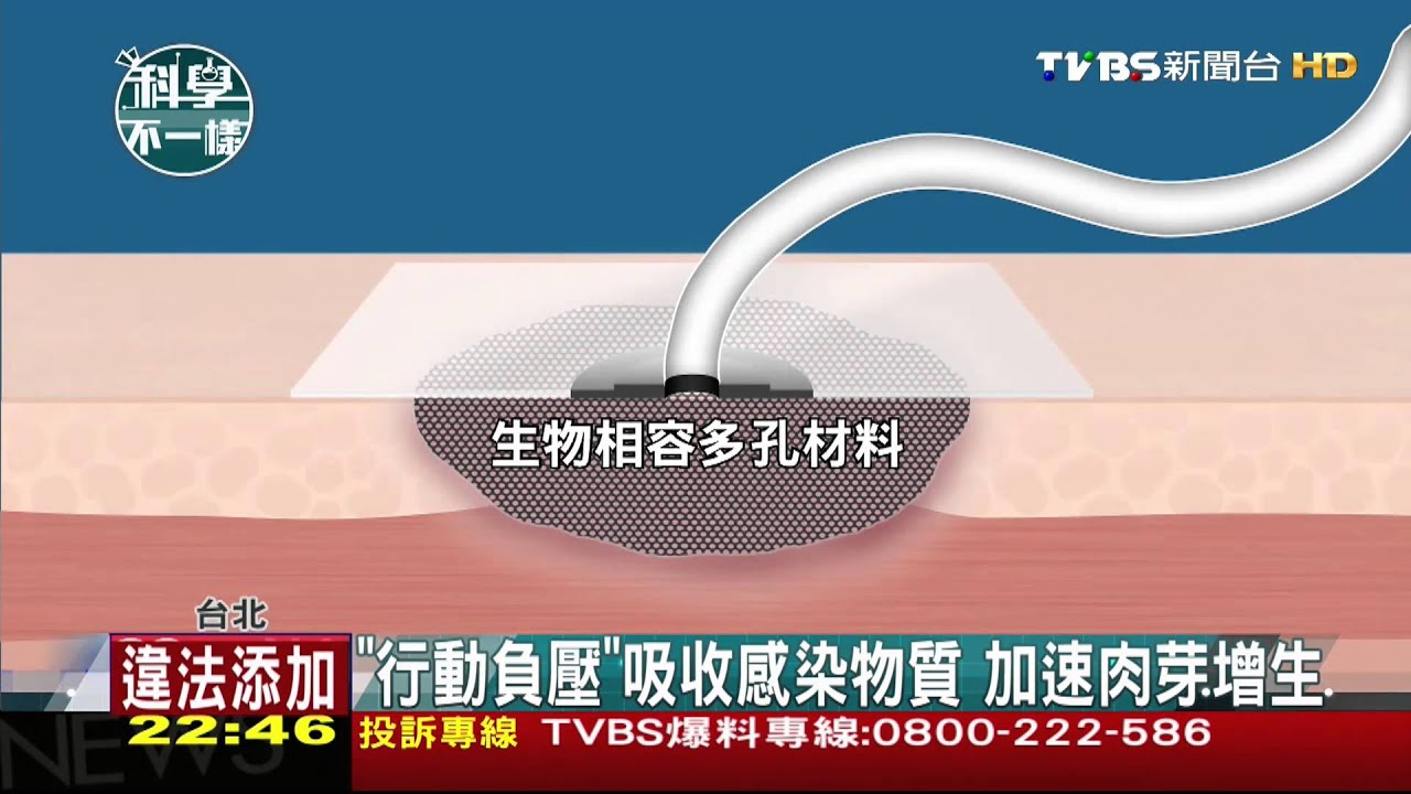 【科學不一樣】「行動負壓」吸收感染物質 加速肉芽增生