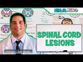 Spinal Cord Lesions Anterior Cord Posterior Cord Central Cord Brown Séquard