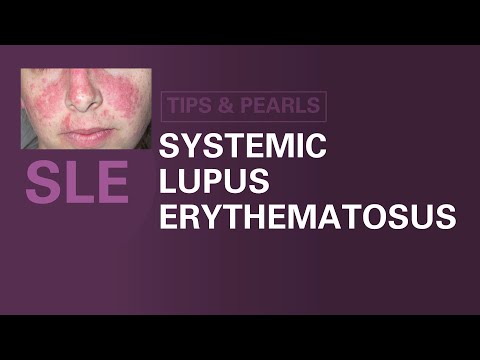 Milyen ízületi fájdalom a lupussal. Az SLE immunológiai háttere