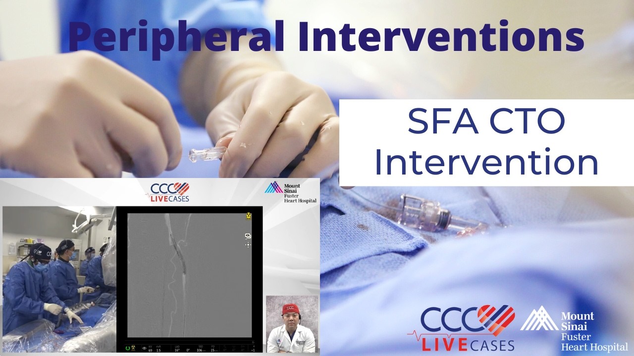 SFA CTO Intervention