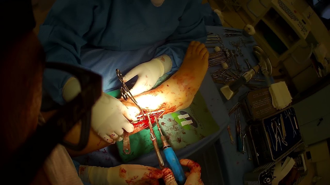 TRATAMENTO CIRÚRGICO DE FRATURA DE TORNOZELO