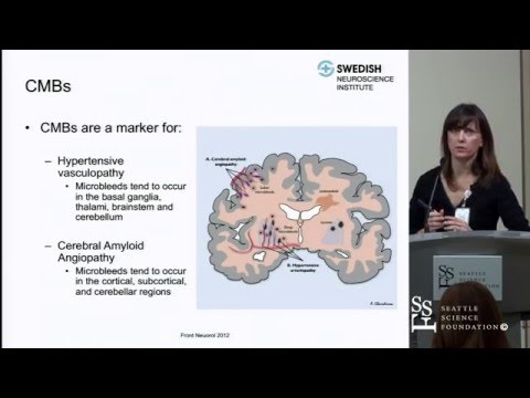Cerebral Microbleeds, Cerebral Amyloid Angiopahthy and Their Clincial Relevance by Sheila Smith, MD