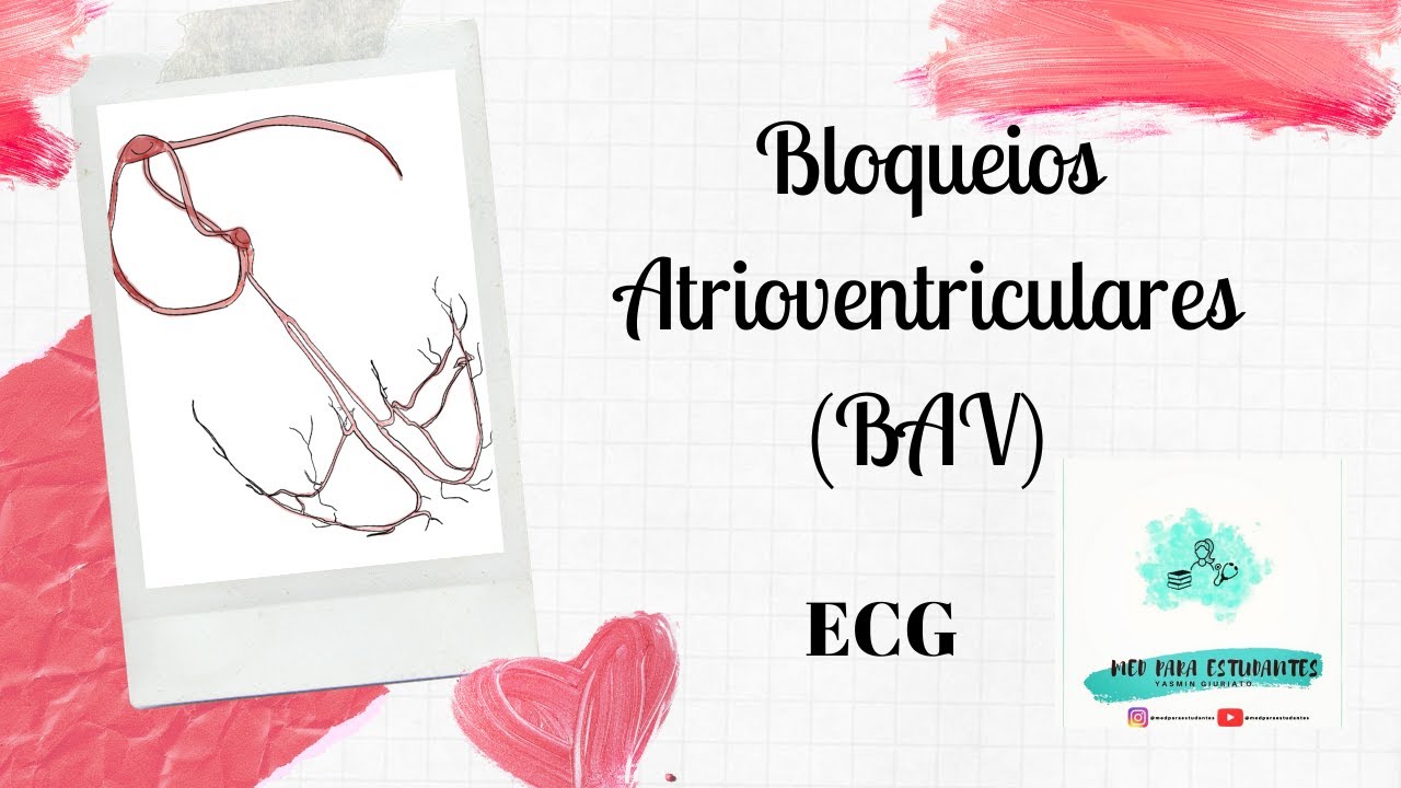 ECG- Bloqueios atrioventriculares (BAV)