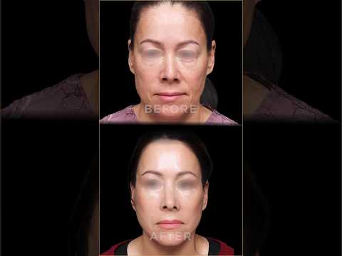 Revitalize Your Look: Facelift & Neck Lift Procedure in Seoul, South Korea