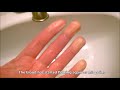Raynaud syndrome: sudden white finger tips