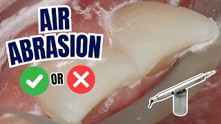 Does Air Particle Abrasion ACTUALLY Improve Clinical Outcomes? - PDP190