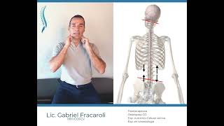 Desnivel pelvico. escoliosis - Gabriel Fracaroli