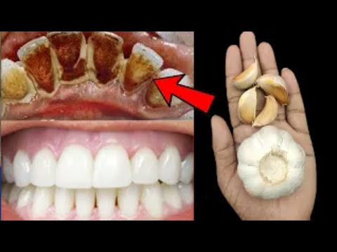 Teeth whitening in 2 minutes || How to whiten your yellow teeth at home and remove tartar
