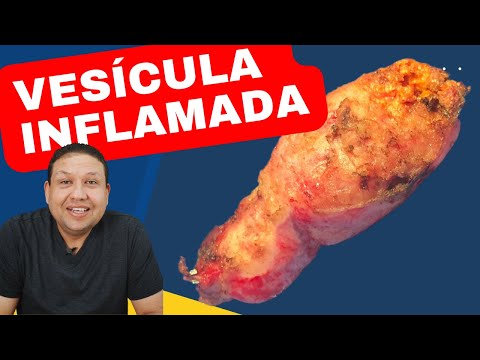 VESÍCULA INFLAMADA ??  Vesícula inflamada, sintomas e tratamento de pedra na vesícula !!!!