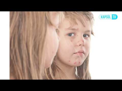 Su Çiçeği Nasıl Tedavi Edilir?