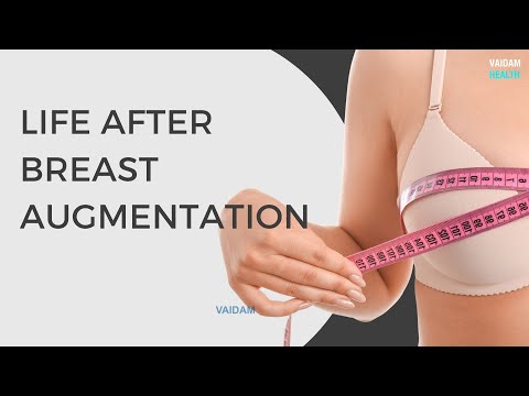 Life After Breast Augmentation