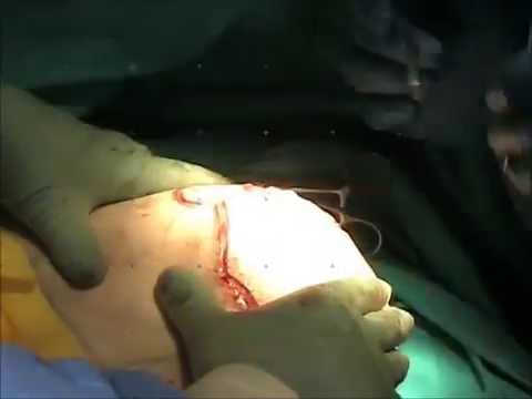 Destinazione osteocondrosi del toracica Iniezioni di vitamine nel osteocondrosi della colonna cervicale