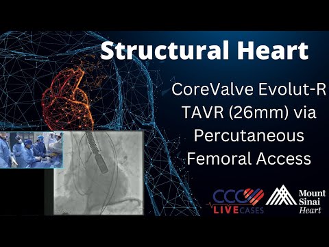 CoreValve Evolut-R TAVR (26mm) via Percutaneous Femoral Access - August 2015 Structural Live Case