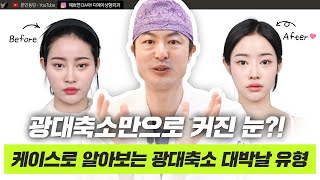 광대 축소하면 대박 나는 얼굴 유형은 따로 있다? ㅣ디에이성형외과