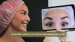 ¿Cómo eliminar arrugas de expresión | Botox