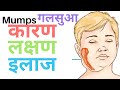 MUMPS | गलसुआ | गलसुआ की दवाई | mumps का इलाज | गलसुआ के ल