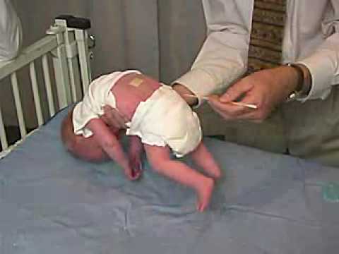 neurology exam: newborn-abnormal: Primitive Reflexes - Galant