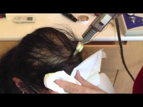 comment soigner xanthelasma