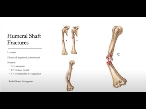 RWJMS Medical Student Journal Club - Humerus Shaft Fractures