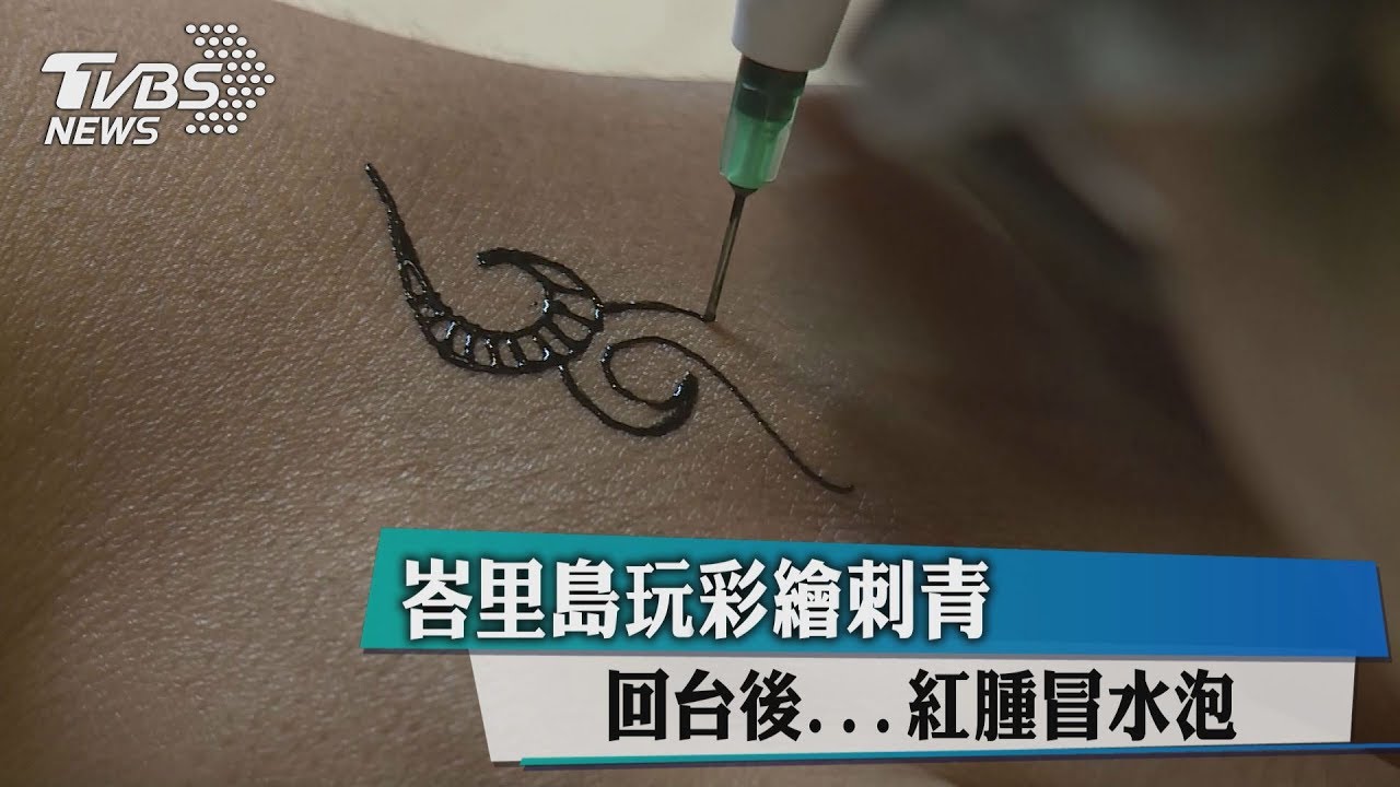 峇里島玩彩繪刺青 回台後…紅腫冒水泡