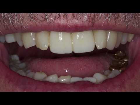 Ersatz von alten PFMs durch BruxZir® Anterior-Kronen