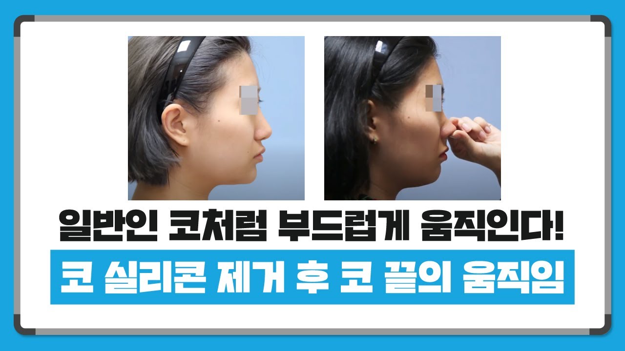 코보형물제거 후에 코끝의 움직임 썸네일