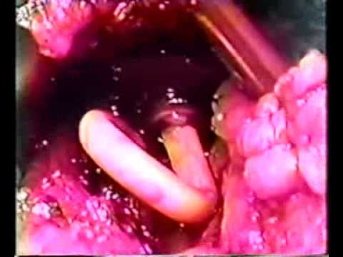 Viele Prostata-Sekret Kongestiver Prostatitis als heilen