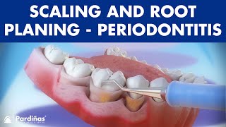 Treatment of periodontal disease - Scaling and root planing - Tartar ©