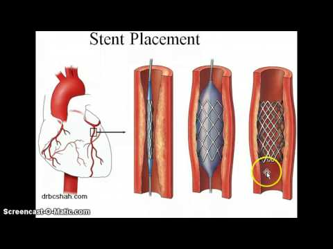 Angioplastyka