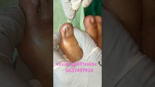 Ep_8652 Foot nails skin removal 👣 หนังมันม้วนอยู่ใต้เล็บ 🙂 (clip from Thailand)