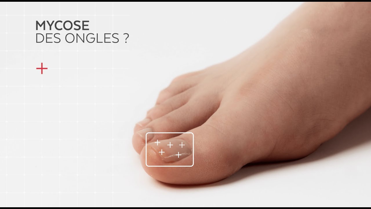 Poderm Huile Sérum Mycose des ongles