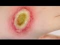 FX MAKEUP SERIES: Third Degree Burns