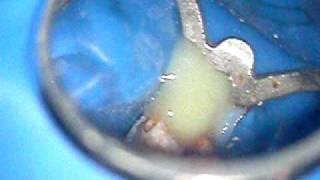 a lot of pus coming from a tooth