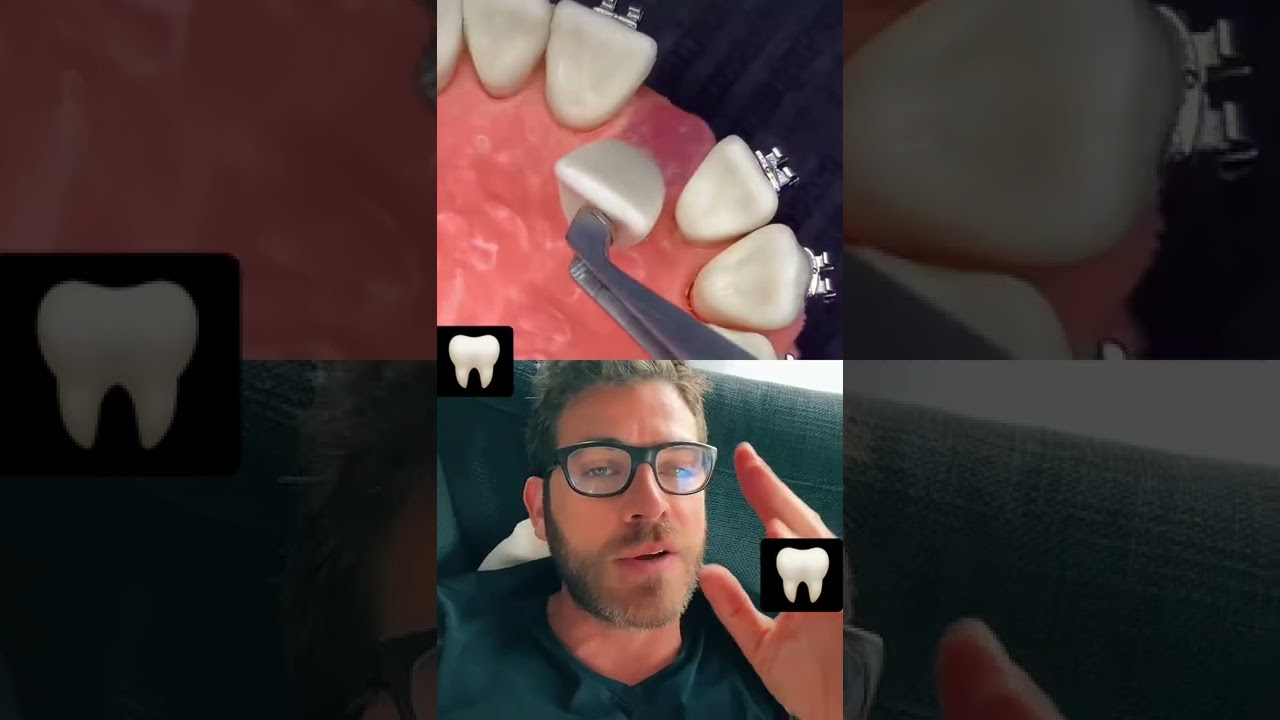 Team appareil dentaire mettez un emoji en comm!?? #shorts