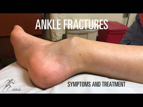 Ankle fracture: Types, signs and symptoms and treatment
